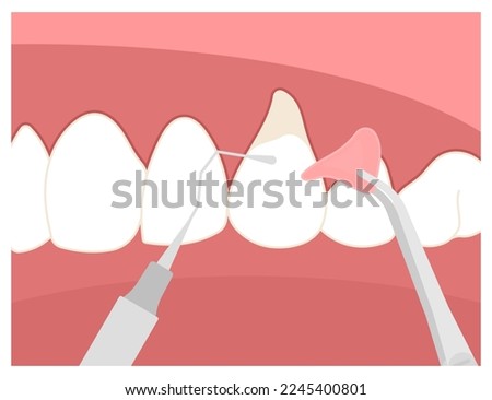 Dentistry root canal decay toothache swelling Teeth grafting procedure for recession gummy smile buildup Loose black cavity abscess oral pain thin injury cosmetic recontouring crown prep Royalty-Free Stock Photo #2245400801