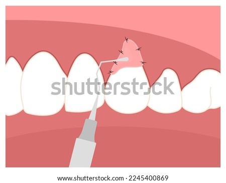 Recession gummy smile dentistry root canal decay toothache swelling Teeth grafting procedure for buildup Loose black cavity abscess oral pain thin injury cosmetic recontouring crown prep Royalty-Free Stock Photo #2245400869