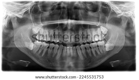 Orthopantomography, OPG X-ray DR digital wisdom teeth. panoramic film x ray dental. Noisy photo Royalty-Free Stock Photo #2245531753