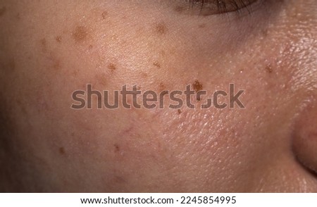 Freckles and brown spots on the oily face of Asian young woman. Royalty-Free Stock Photo #2245854995