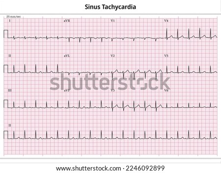 NON-REENTRANT-TACHYCARDIA Stock Vector Images - Avopix.com