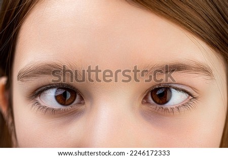 Strabismus. Close-up part child's face, eyes girl. Little patient strabismus, treatment ophthalmic diseases. Strabismus in children causes, treatment concept. Female eyes with strabismus. Hypertropia. Royalty-Free Stock Photo #2246172333