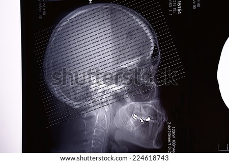 Profile view with a human skull X Ray on black background