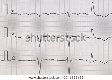 Electrocardiogram with atrial flutter and a ventricular extrasystole Royalty-Free Stock Photo #2246811611