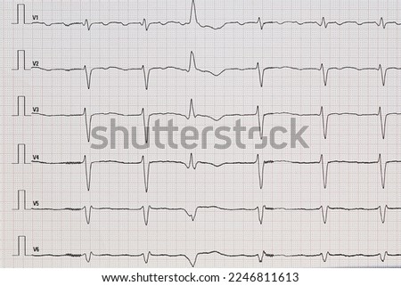 Electrocardiogram with atrial flutter and a ventricular extrasystole Royalty-Free Stock Photo #2246811613