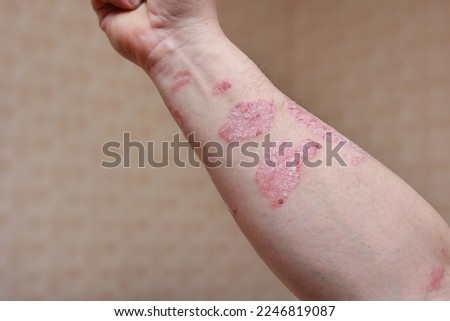 Man with sick arm, dry flaky skin on his hand with vulgar psoriasis sores, allergy, eczema and other skin diseases such as fungus, plaque, rash and blemishes. Autoimmune genetic disease Royalty-Free Stock Photo #2246819087