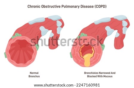 Chronic obstructive pulmonary disease. Chronic inflammatory lung disease that causes obstructed airflow from the lungs. Breathing-related problem. Flat vector illustration Royalty-Free Stock Photo #2247160981