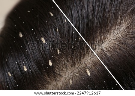 Collage showing woman's hair before and after lice treatment, closeup. Suffering from pediculosis