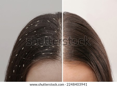 Collage showing woman's hair before and after lice treatment on light background, closeup. Suffering from pediculosis