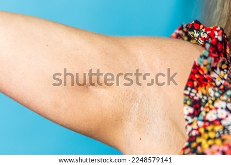 A close up image of a woman's athletic arm with muscles and a deep indent atrophic scar from a lump cyst lipoma removal Royalty-Free Stock Photo #2248579141