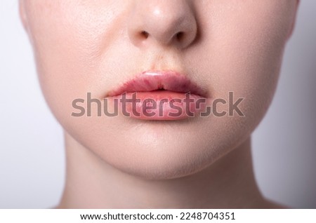 real women's bruised lips after lip augmentation injection of hyaluronic acid close-up, complications and hematomas after a beauty hyaluronan injection on female lips, contour lip plastic surgery Royalty-Free Stock Photo #2248704351