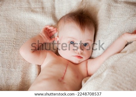 Portrait of a positive girl with Down syndrome. Scar after heart surgery Royalty-Free Stock Photo #2248708537