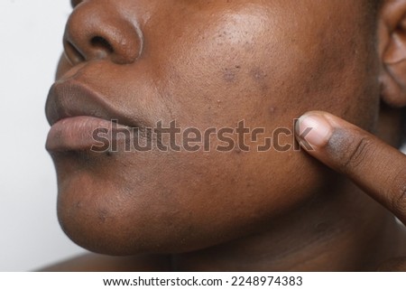 Brown skin with dark spots, hyperpigmentation on brown skin, african american woman with skin blemishes, imperfect skin Royalty-Free Stock Photo #2248974383