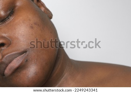 Brown skin with dark spots, hyperpigmentation on brown skin, african american woman with skin blemishes, imperfect skin Royalty-Free Stock Photo #2249243341