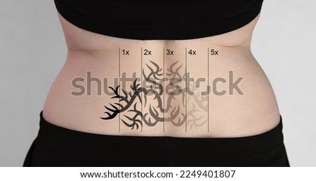 Rear View Of Laser Tattoo Removal On Woman's Hip Royalty-Free Stock Photo #2249401807