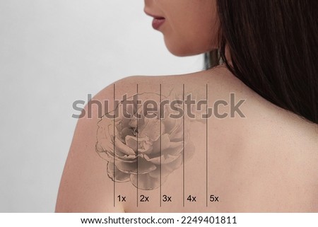 Laser Tattoo Removal On Woman's Shoulder. Medical Treatment Royalty-Free Stock Photo #2249401811