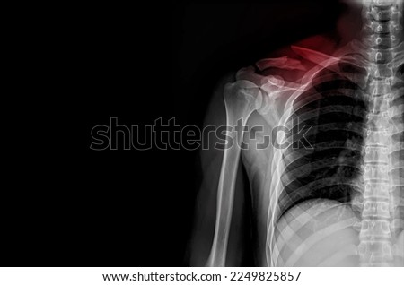 Fracture clavicle.Plain radiograph of human shoulder after accident.The film shown calcific tendinitis of rotator cuff.Patient came to hospital with severe pain.Medical concept.Motor vehicle accident. Royalty-Free Stock Photo #2249825857