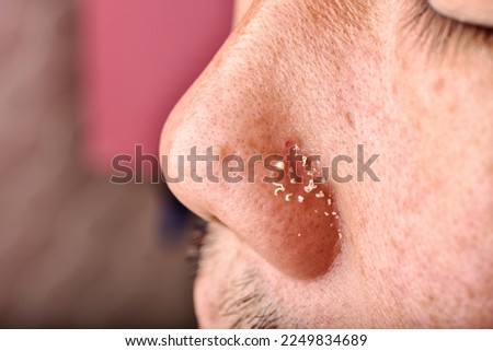 Men skin problem, Acne squeeze, Whitehead comedone pus extraction, Close up man face with clogged pores pimple on nose, Scar and oily greasy face, Beauty concept. Royalty-Free Stock Photo #2249834689