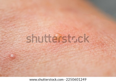 Closeup skin with Dyshidrotic Eczema , skin disease problems
