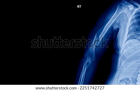 Photo of plain radiograph on dark background in hospital. The film use for diagnosis the illness of patient.Medical concept.The picture of film x-ray right shoulder of humeral shaft fracture patient.