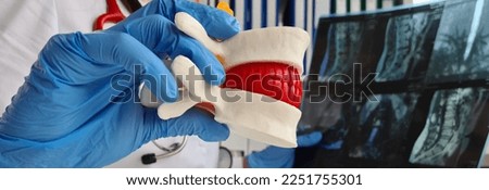 Closeup of therapist holding an anatomical model of vertebrae with herniated disc. Treatment of intervertebral hernia concept