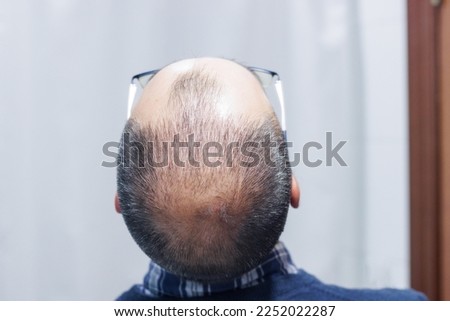 Young man with alopecia looking at his head and hair in the mirror at home Royalty-Free Stock Photo #2252022287