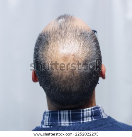 Young man with alopecia looking at his head and hair in the mirror at home Royalty-Free Stock Photo #2252022295