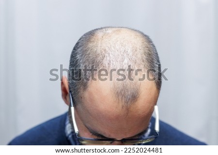 Young man with alopecia looking at his head and hair in the mirror at home Royalty-Free Stock Photo #2252024481
