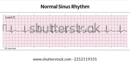 ECG Normal Sinus Rhythm - 8 Second ECG Paper - Vector Medical Illustration Royalty-Free Stock Photo #2252119331