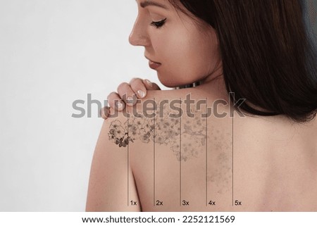 Laser Tattoo Removal On Woman's Shoulder. Medical Treatment Royalty-Free Stock Photo #2252121569