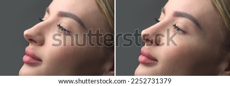 Nose Before and after plastic surgery. Rhinoplasty. Crooked nose correcting. Young woman profile portrait, over grey background. Beauty female, model girl face close-up. Aesthetic medicine Royalty-Free Stock Photo #2252731379