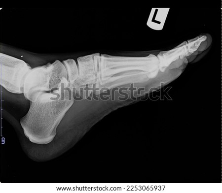 Doctor Looking at X-Ray Radiography, X-Ray Image Of human foot ankel and leg xray picture.