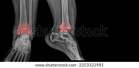 Ankle x-ray showing ankle fracture. Black and white tone. Black background.