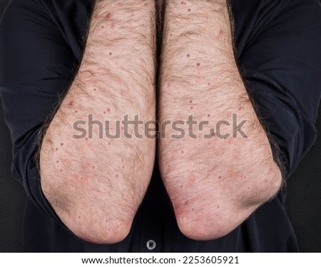 Measles. Viral disease of immunodeficiency dermatitis rash on the body of a man, scratch with itching, viral exanthema. A patient with monkeypox. Painful rash, red spots, blisters on the arm. Royalty-Free Stock Photo #2253605921