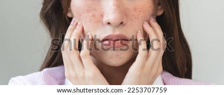 young female have freckles on her face. Royalty-Free Stock Photo #2253707759