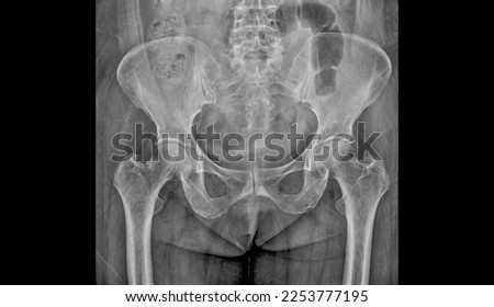 Photo of plain radiograph on dark background in hospital. The film use for diagnosis the illness of patient.Medical concept. X-ray shown non displace fracture femoral neck in osteoporosis elderly. Royalty-Free Stock Photo #2253777195