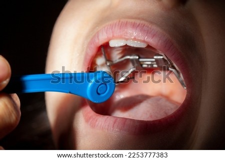 Close up isolated image of a young caucasian girl opening her mouth wide. On upper jaw there is a palatal expander and orthodontist or parent uses a turn key to rotate the screw and adjust expansion. Royalty-Free Stock Photo #2253777383