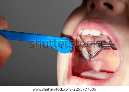 Close up isolated image of a young caucasian girl opening her mouth wide. On upper jaw there is a palatal expander and orthodontist or parent uses a turn key to rotate the screw and adjust expansion. Royalty-Free Stock Photo #2253777385