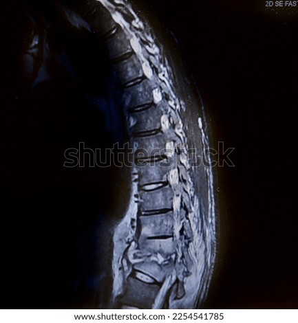 Vertebral osteomyelitis and discitis with T11-12 collapse, kyphosis Royalty-Free Stock Photo #2254541785