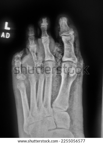 Gangrenous left foot in diabetic patient - soft tissue gas on Xray