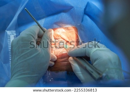 Phacoemulsification, destruction of the opaque lens by ultrasound, ophthalmic eye surgery. eye lens replacement, surgical cataract treatment.closeup cataract. Royalty-Free Stock Photo #2255336813