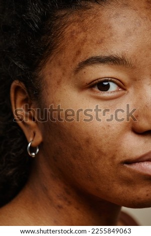 Vertical macro shot of acne scars on face of young black woman looking at camera Royalty-Free Stock Photo #2255849063