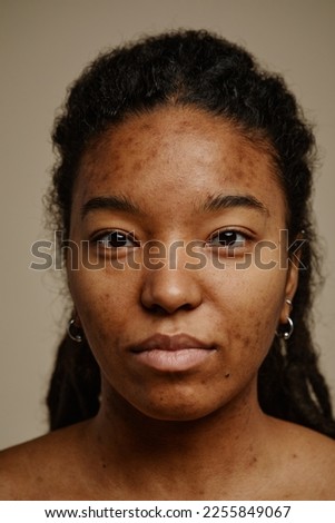 Vertical close up portrait of ethnic young woman looking at camera, focus on real skin texture and acne scars on face