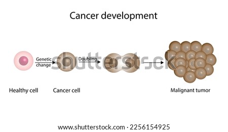 Process of cancer cell development. Cancer disease development. Malignant tumor. Medical biological, science vector illustration.
 Royalty-Free Stock Photo #2256154925
