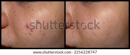 Before and after treatment of acne vulgaris, black spots and freckles on the oily face of Southeast Asian young woman. Royalty-Free Stock Photo #2256228747