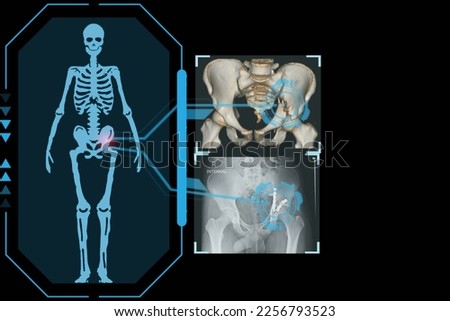 Examines a technological digital holographic plate representing the patient's body, Transverse fracture of acetabulum pelvis, Concept: Futuristic medicine, Medical technology concept. Royalty-Free Stock Photo #2256793523