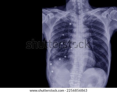 A middle-aged man's chest x-ray showing foreign bodies in his heart and lungs. resembling a bullet, black background Royalty-Free Stock Photo #2256856863