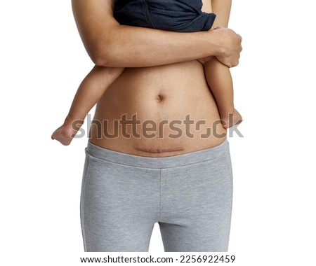 Woman belly with a scar from a cesarean section with her baby's legs on white background                                                                 