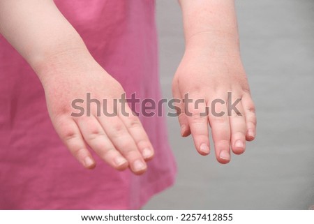 hands of a child with dry atopic skin, red inflammation on the skin, diathesis, allergy on the child's body.irritation and pruritus. Royalty-Free Stock Photo #2257412855