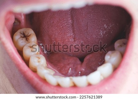 Tooth's a man smoking bad. man smokes a cigarettes have tooth decay and calculus on teeth, So we should be care dental with the hygiene. Royalty-Free Stock Photo #2257621389